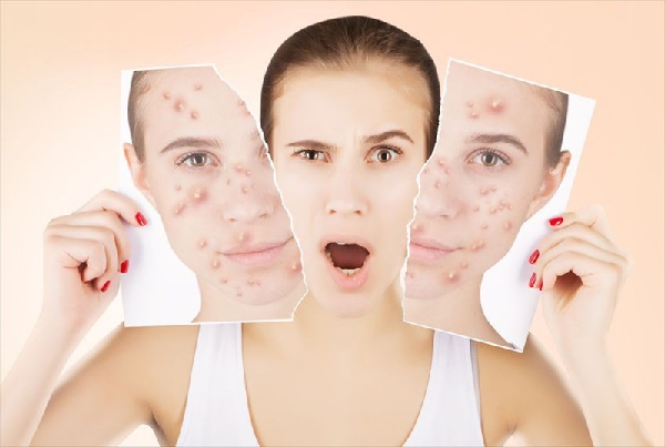 Chemical Peels