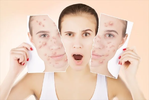Chemical Peels
