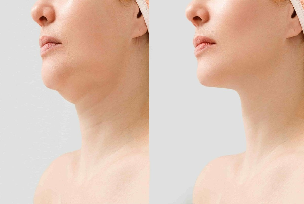Fat Dissolving Injections