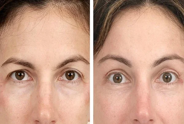 Eyebrow Lift