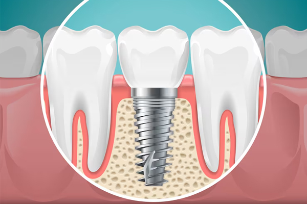 Dental Implants