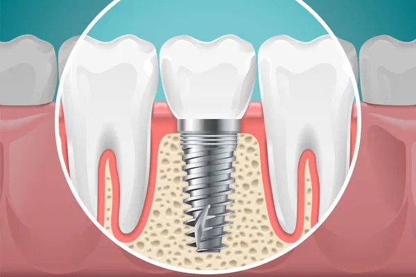 Dental Implants